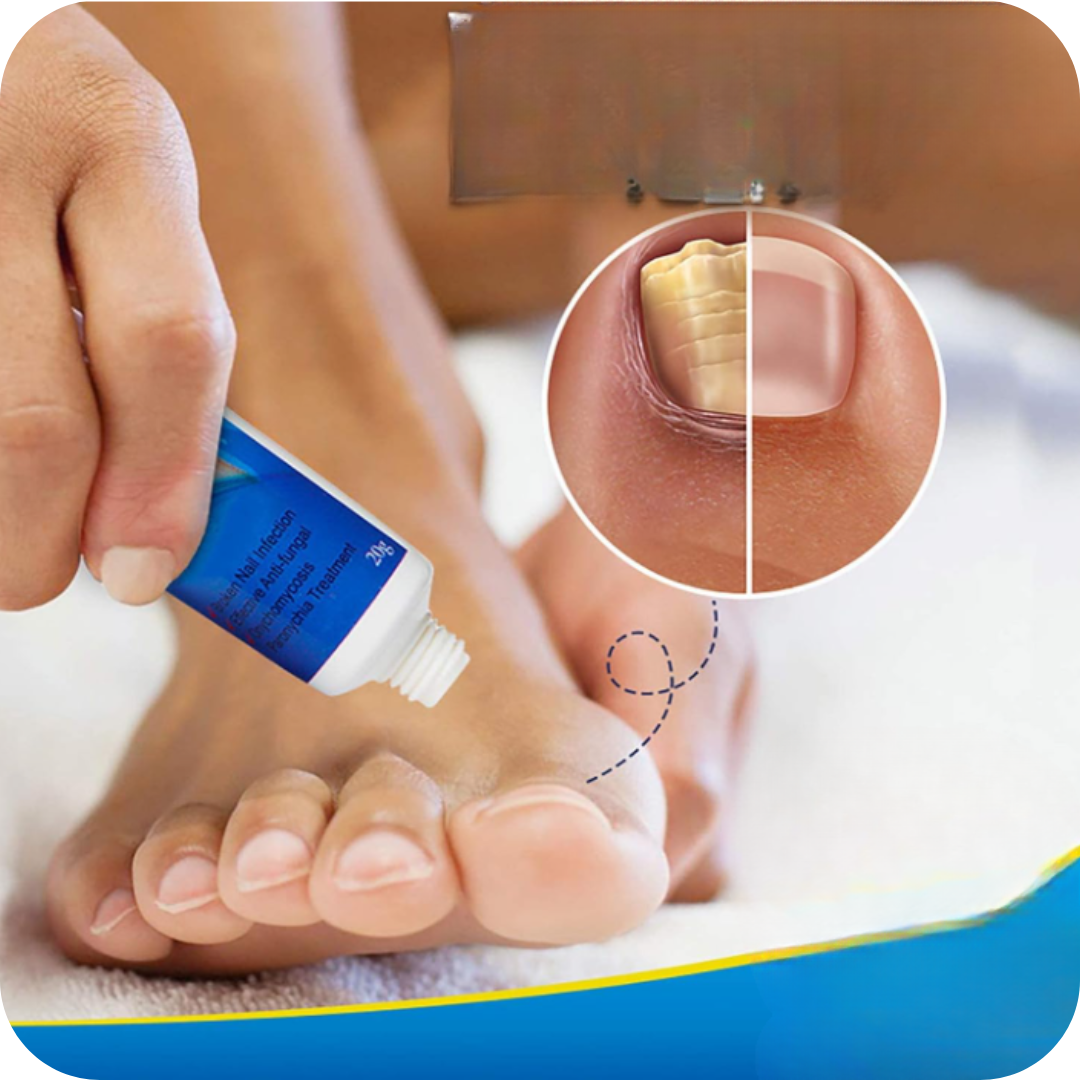 Crema Anti Hongos para los Pies | NailFungus®