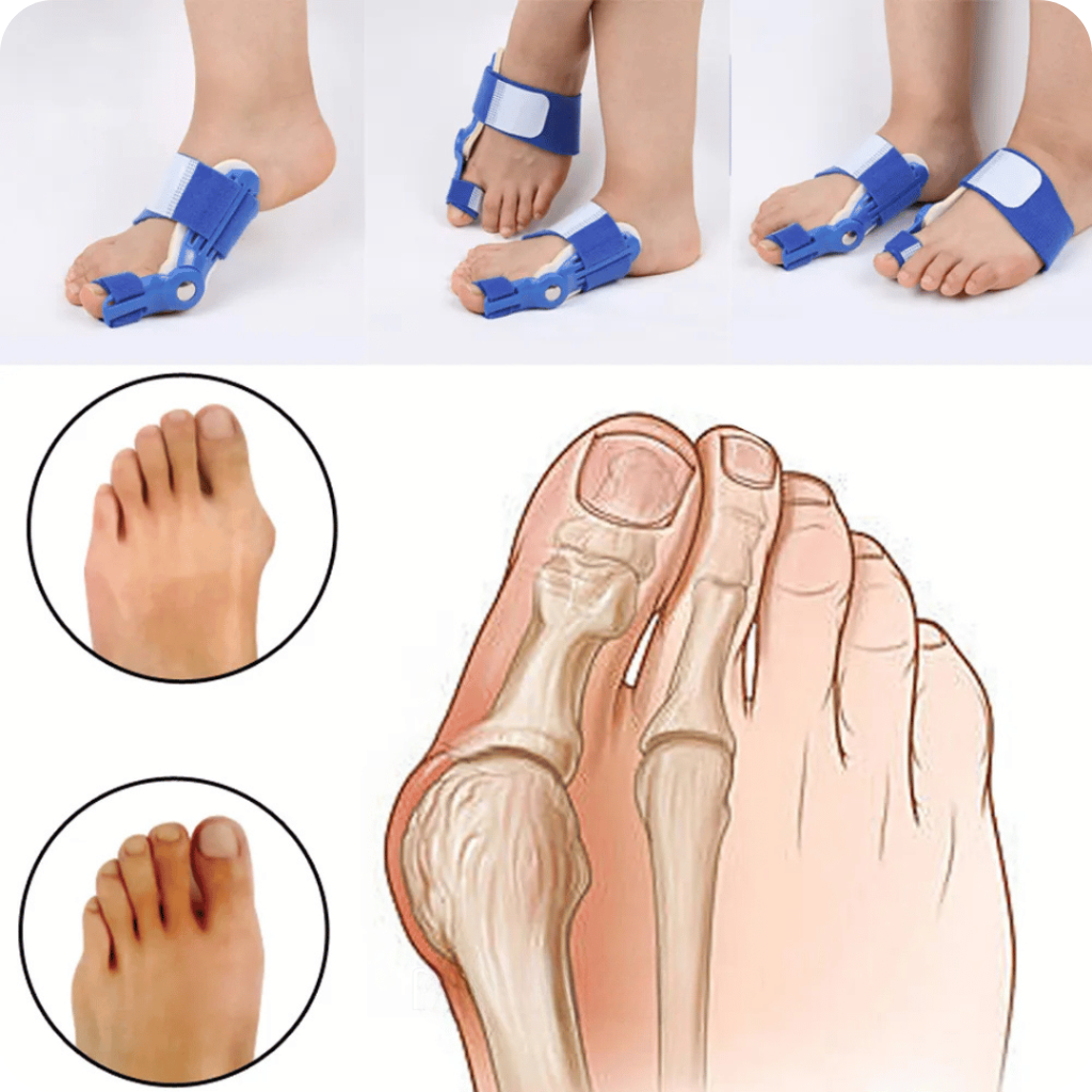 Corrector de Juanetes Ortopédico | PediFlex®