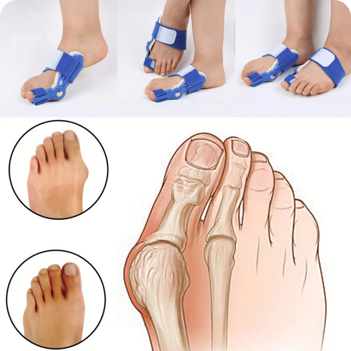 Corrector de Juanetes Ortopédico | PediFlex®